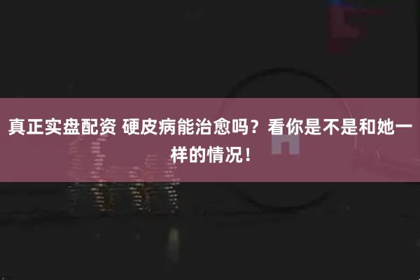 真正实盘配资 硬皮病能治愈吗？看你是不是和她一样的情况！